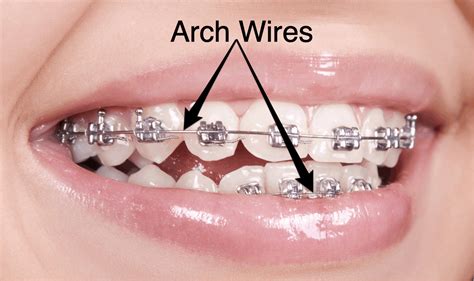 the final wire for braces